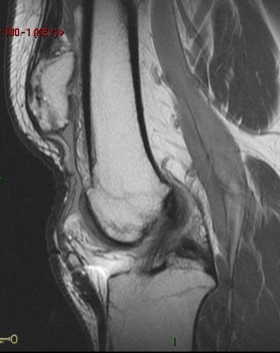 Figure 2 for case Patellar tendon re-tear